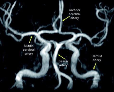 Circle of Willis, Angiogram anterior communicating artery aneurysms ...