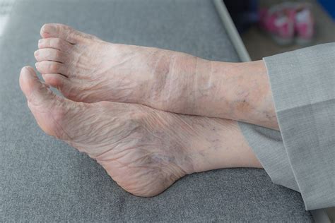 How Aging Affects Our Feet – Welcome To Agecare