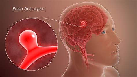 Brain Aneurysm Shown & Explained Using A 3D Medical Animation