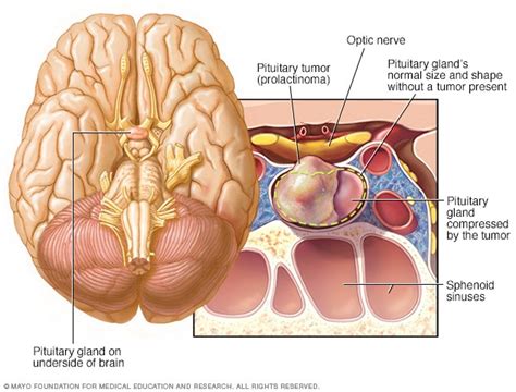 Prolactinoma - Symptoms and causes - Mayo Clinic