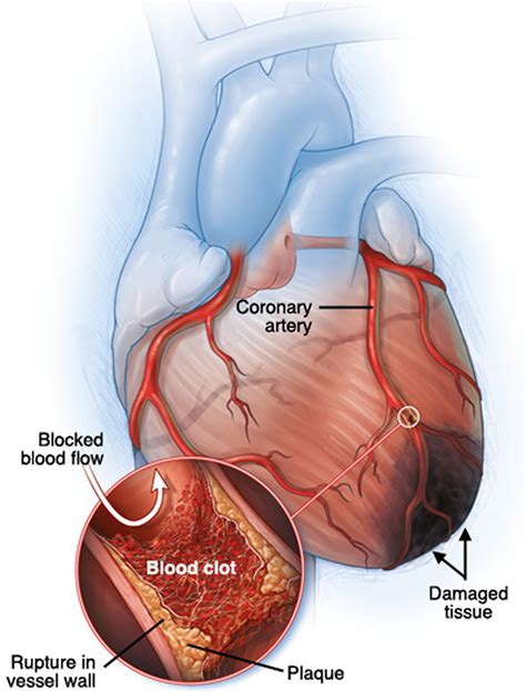 Myocardial Ischemia