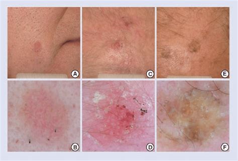 Skin Cancer Actinic Keratosis Hand