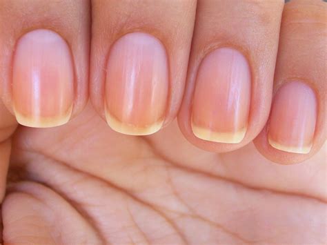 What Vitamin Deficiency Causes Vertical Lines In Nails - Design Talk