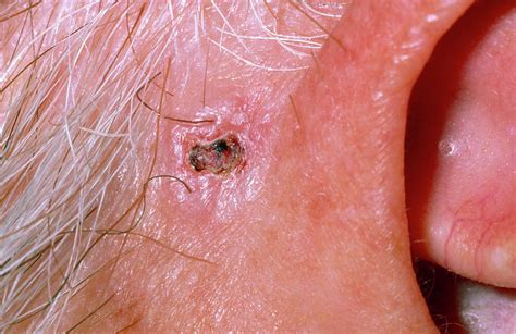 Rodent Ulcer Next To Ear Photograph by Dr P. Marazzi/science Photo Library