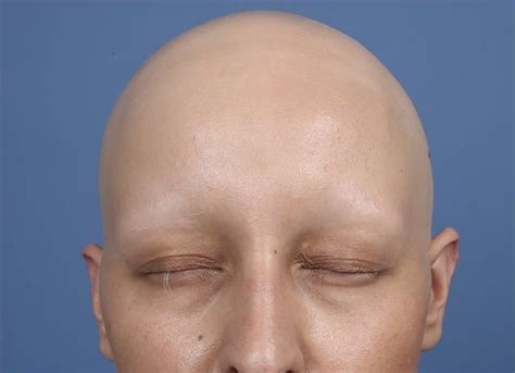 Alopecia universalis causes - destinationGros