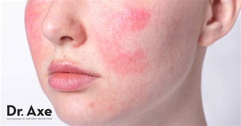 Rosacea Treatment: 6 Natural Remedies to Use - Dr. Axe