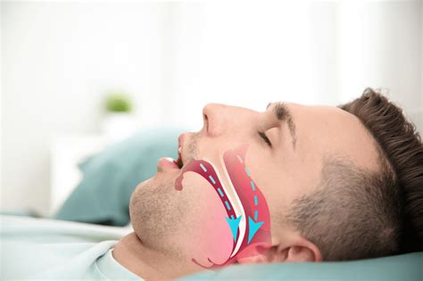 Worldwide Sales of Sleep Apnea Implants are predicted to increase at a ...