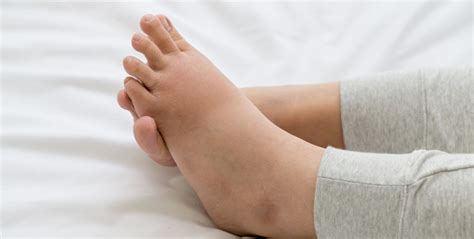 WHAT CAUSES EDEMA? - Lexington Vein Institute