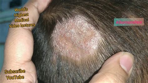 Fungal Infection Of The Scalp (Tinea Capitis) Causes, Risk Factors ...