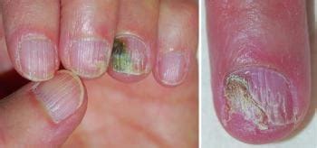 Green Nail Syndrome - Skin Disorders - MSD Manual Consumer Version