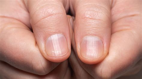 11 Tips For Getting Rid Of Unsightly Fingernail Ridges