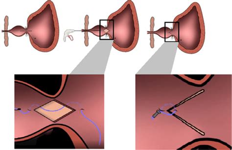 Transurethral Incision with Transverse Mucosal Realignment for the ...