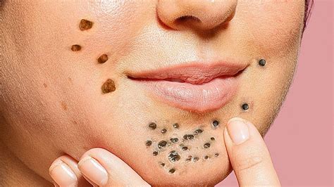 Newest Blackhead Removal Videos 2024 – Youtube - Eula Laurella