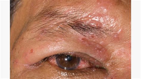 Shingles In the Eye: Signs, Treatment, Outlook, and More