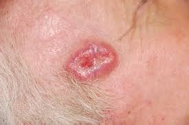 Basal Cell Carcinoma (Rodent Ulcers) (print version)