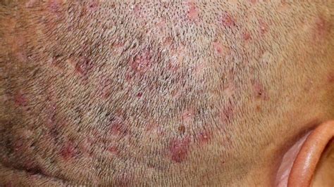 Scabs on Scalp: Everything You Need to Know - Wimpole Clinic