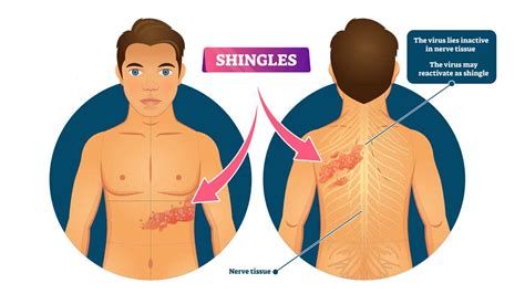 Doctors Explain the Causes and Symptoms of Shingles | Power of ...