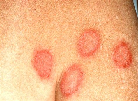 Nummular Eczema - Pictures, Causes, Symptoms, Treatment