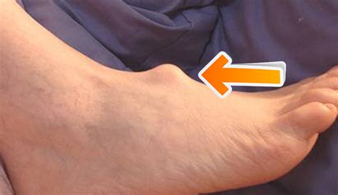 cyst on top of foot | Ganglion Cysts | Information, Treatments & Remedies