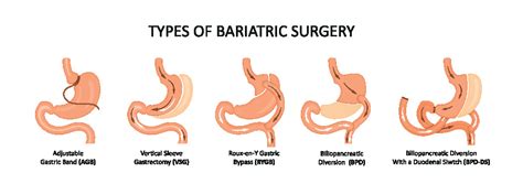 Bariatric surgery - The Johns Hopkins Patient Guide to Diabetes