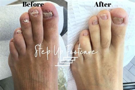 Laser Toenail Fungus Treatment | Podiatrist NYC Downtown | Step Up Footcare