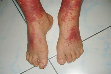 What Is Vasculitis? Symptoms, Causes, & Treatment