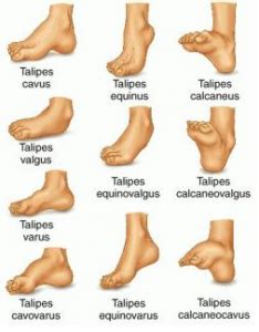 Understanding Talipes - Club Foot - torc2.comtorc2.com