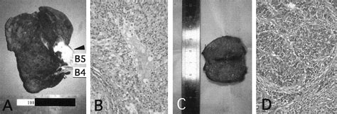 A case of paraneoplastic syndrome accompanied by two types of cancer ...