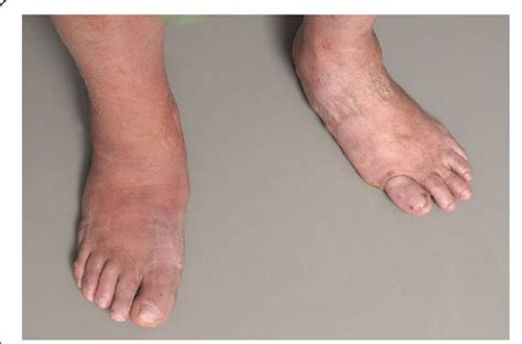 A typical Charcot foot in acute active phase: red, hot, and swollen ...