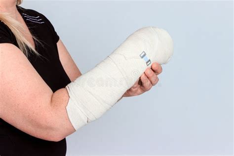 Young Female with Broken Hand in Cast Stock Image - Image of ache ...