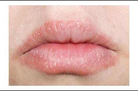 Allergic Contact Cheilitis From a Variety of Lip Balm Ingredients ...