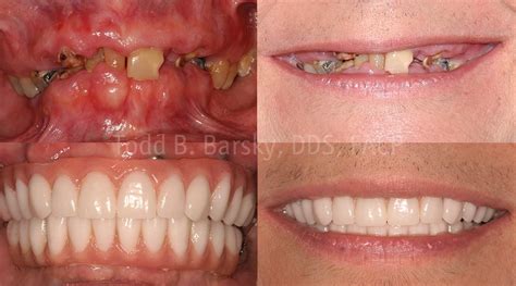 Tooth Implant Before After