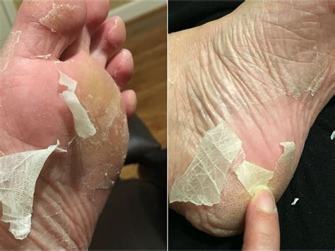 Peeling Foot Skin | atelier-yuwa.ciao.jp