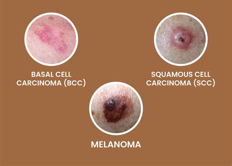 Skin Cancer: Types, causes, symptoms and treatment | Dr. Priya Tiwari