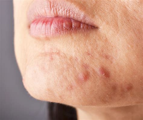 Hormonal Acne: Causes, Symptoms, and Targeted Treatments - Freyja Medical