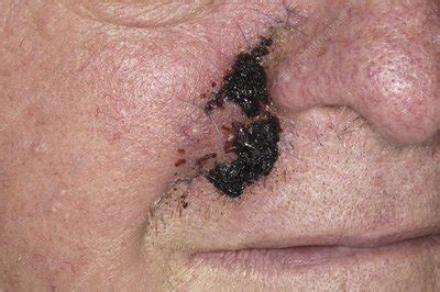 Basal cell carcinoma surgery - Stock Image - M332/0175 - Science Photo ...