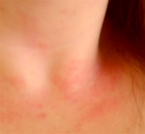 Lupus Rash On Neck And Chest