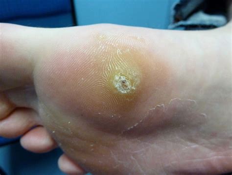 Plantar Wart Early Symptoms at Aileen Laura blog