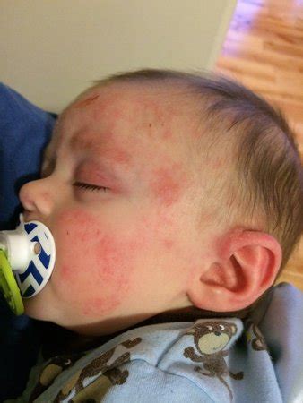 Sudden eczema flare up in infant | BabyCenter