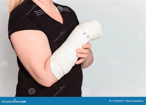 Young Female with Broken Hand in Cast Stock Photo - Image of anatomy ...