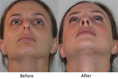 Enhance Your Appearance with New York City Nose Surgery