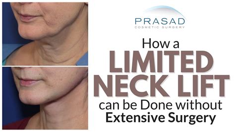 Why Best Neck Lift Results Require Surgery, but a Limited Lift can be ...