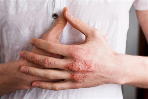 How to Prevent Eczema Flare-Ups This Summer: Apex Dermatology: Skin ...