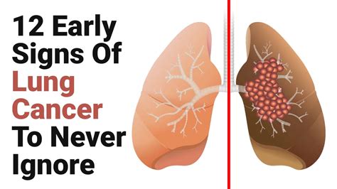 Symptoms of Lung Cancer – Restaurant DA Rosa