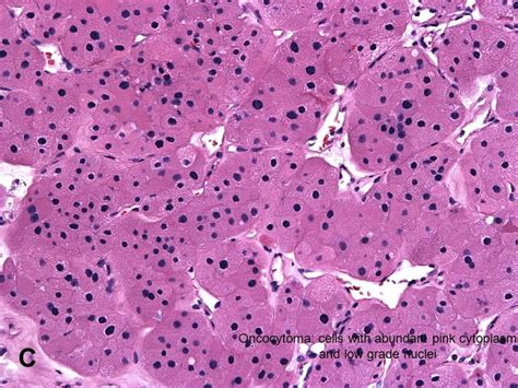 American Urological Association - Renal Oncocytoma