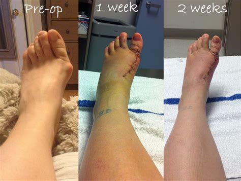 French Bunion Soup: Two Weeks Post-op: My second foot unveiling