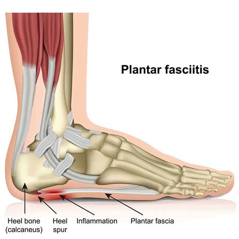 Heel Pain (Plantar Fasciitis): Causes, Treatments, and Prevention ...