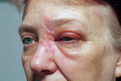 Shingles Rash Photograph by Victor De Schwanberg/science Photo Library ...