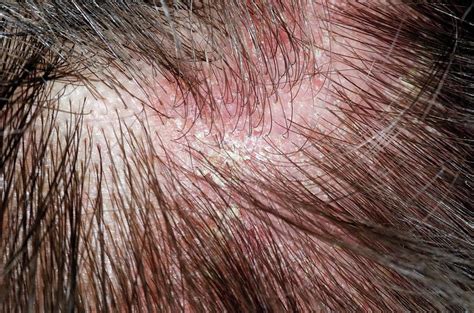 Psoriasis On The Scalp Photograph by Dr P. Marazzi/science Photo Library