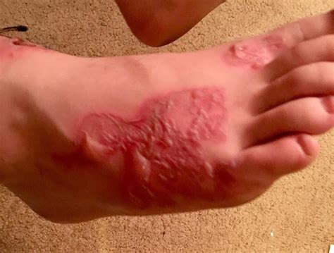 How do you get hookworms? Teen's infection raises questions - CBS News